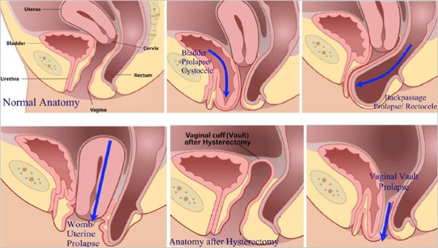 Prolapse